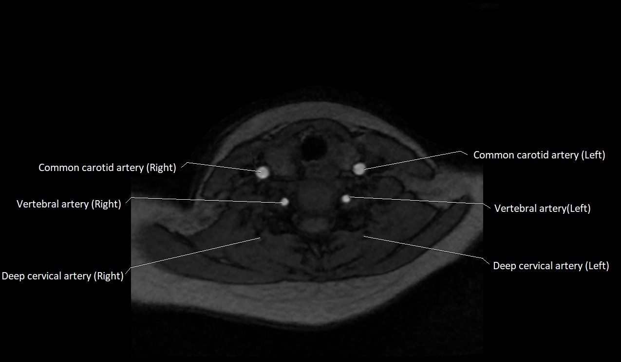 Carotid artery anatomy axial 3T image 48.jpg
